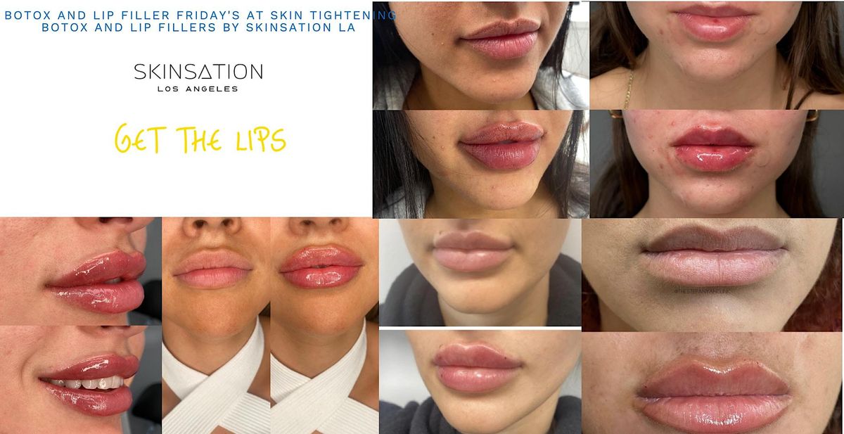 Lip Filler and Botox Friday's at our Medical spa in Los Angeles, California